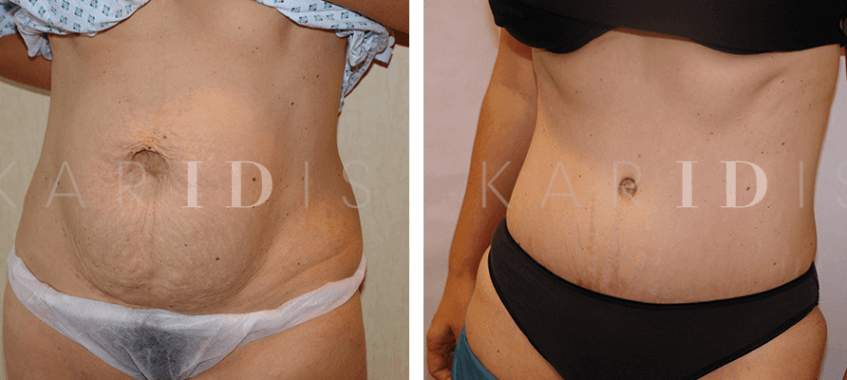 Tummy tuck with abdominal muscle tightening results