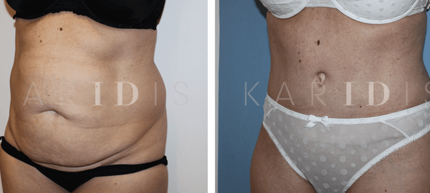 Tummy tuck with lipo results)