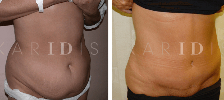 Tummy tuck with lipo to waist before and afters