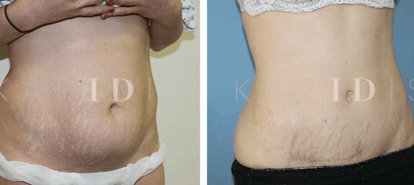 Tummy tuck with lipo to waist results