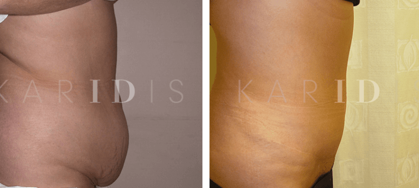 Tummy tuck with lipo to waist results