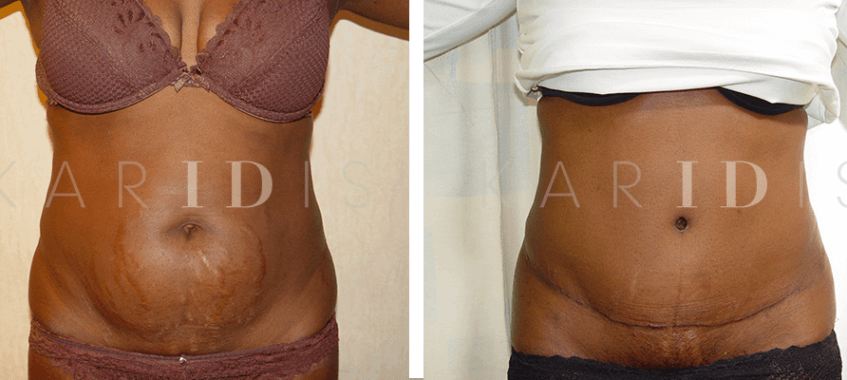 Tummy tuck with liposuction to the waist results