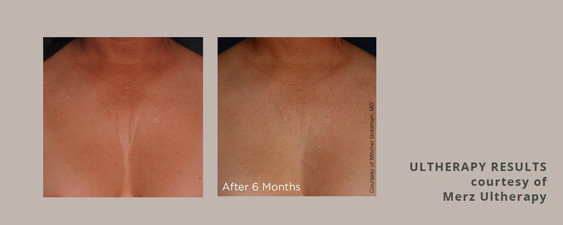 Ultherapy for the chest