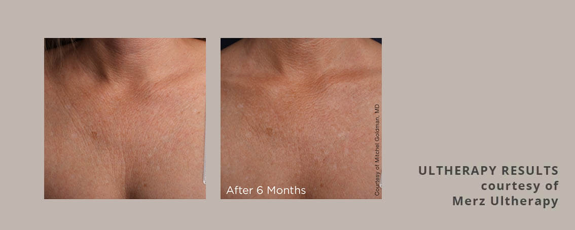 Ultherapy for the decolletage