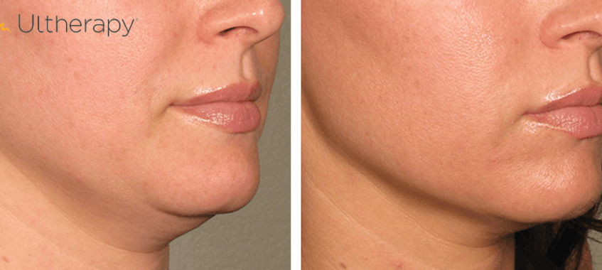 Ultherapy lower facelift
