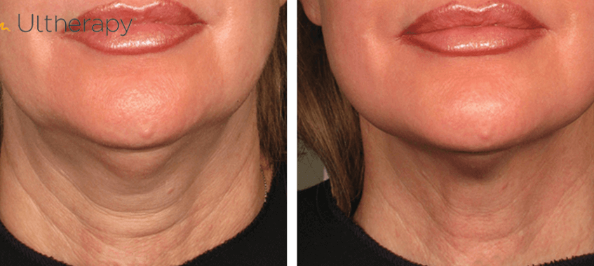 Ultherapy neck lift