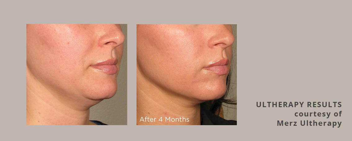 Ultherapy skin tightening for jowls