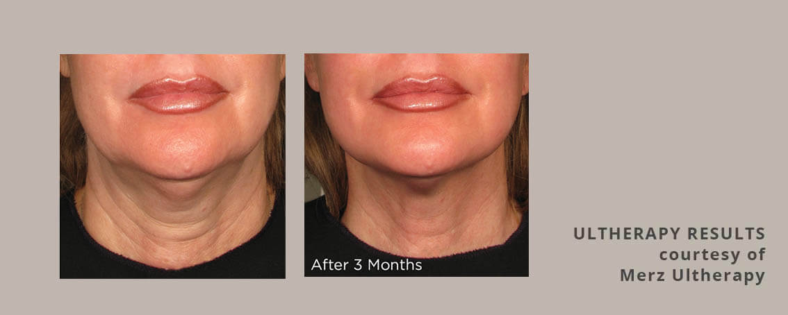 Ultherapy skin tightening results