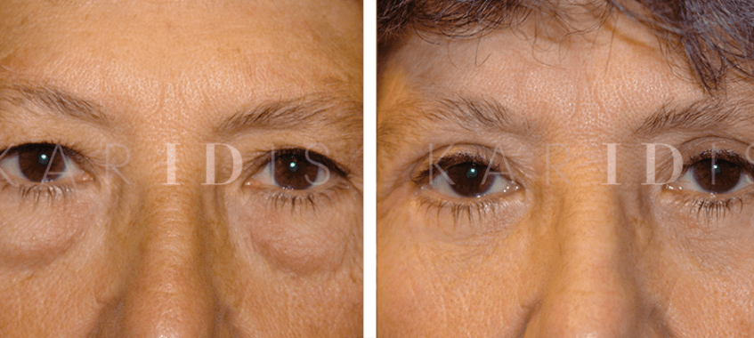 Upper and Lower Blepharoplasty