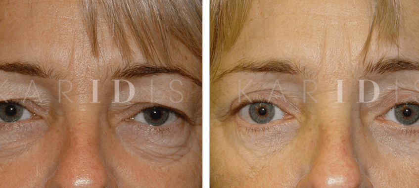 Upper and Lower Blepharoplasty Results