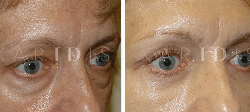 Upper and Lower Eyelid Lift Before and Afters