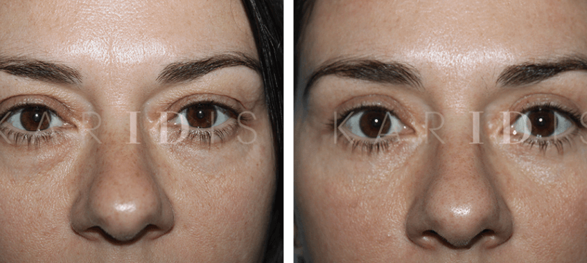 Upper and Lower Eyelid Lift Results