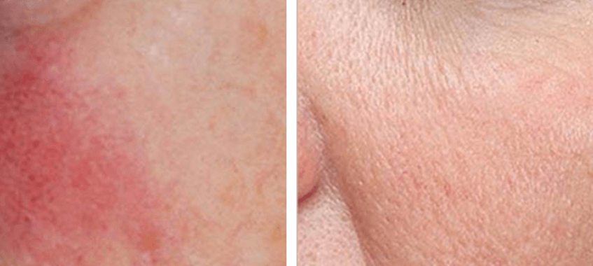 VBeam for Rosacea