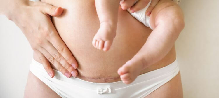 hanging belly after a C-section